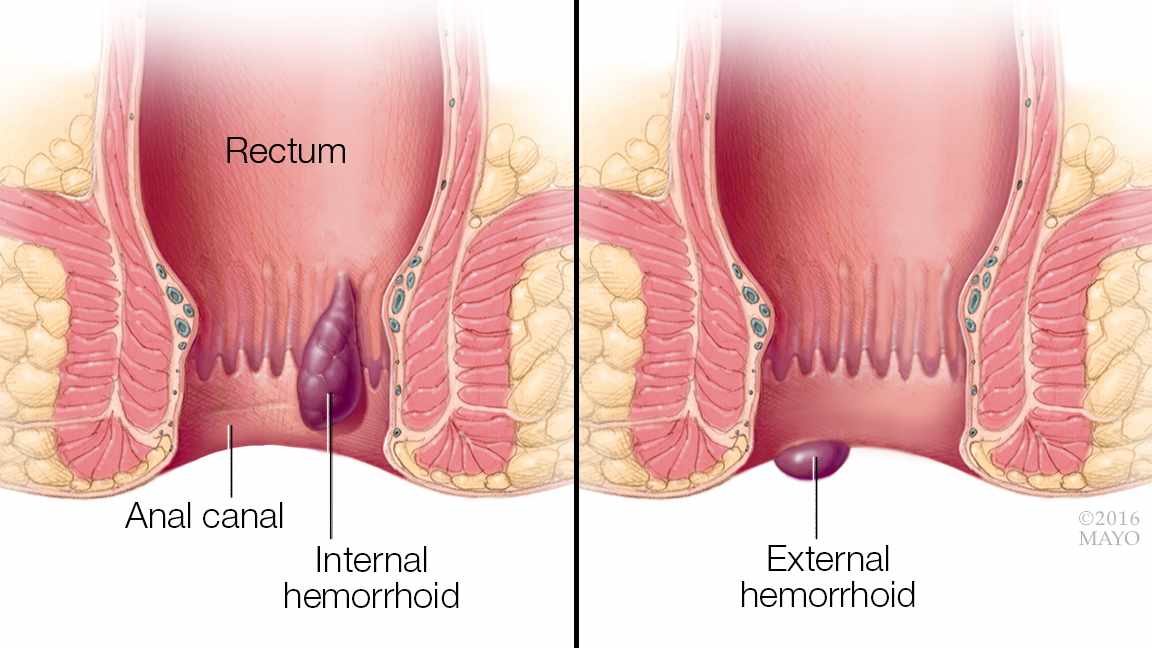 hemoroid internal dan external pengobatan wasir tanpa rasa sakit