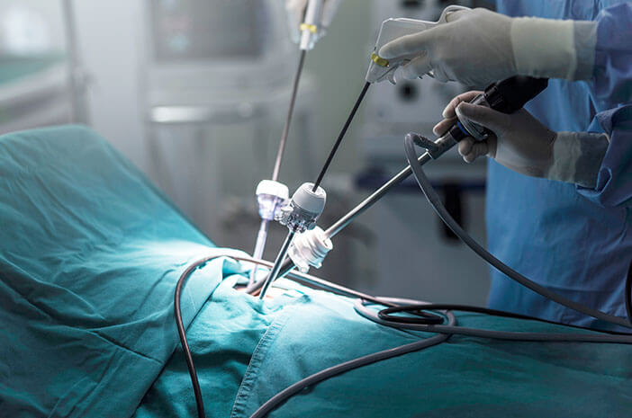 bedah laparoskopi operasi laparoskopi
