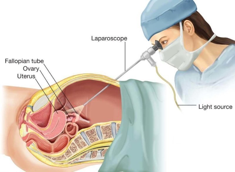 bedah laparoskopi operasi laparoskopi